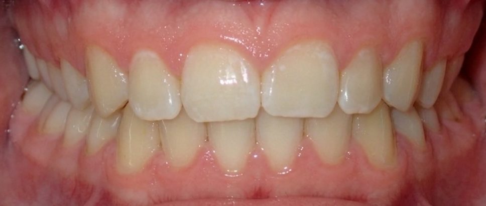 Vivid Smiles patient case 7 before and after treatment comparison after